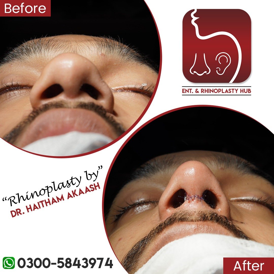 ENT. & RhinoPlasty Hub