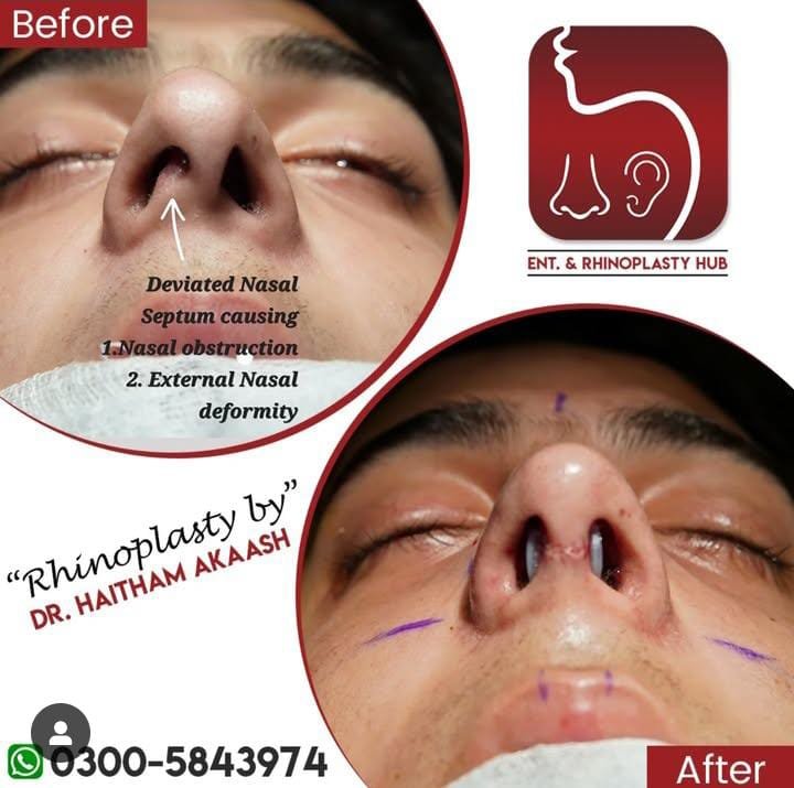 ENT. & RhinoPlasty Hub