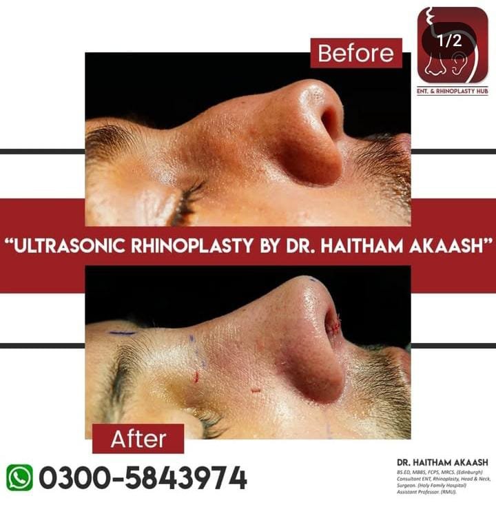 ENT. & RhinoPlasty Hub