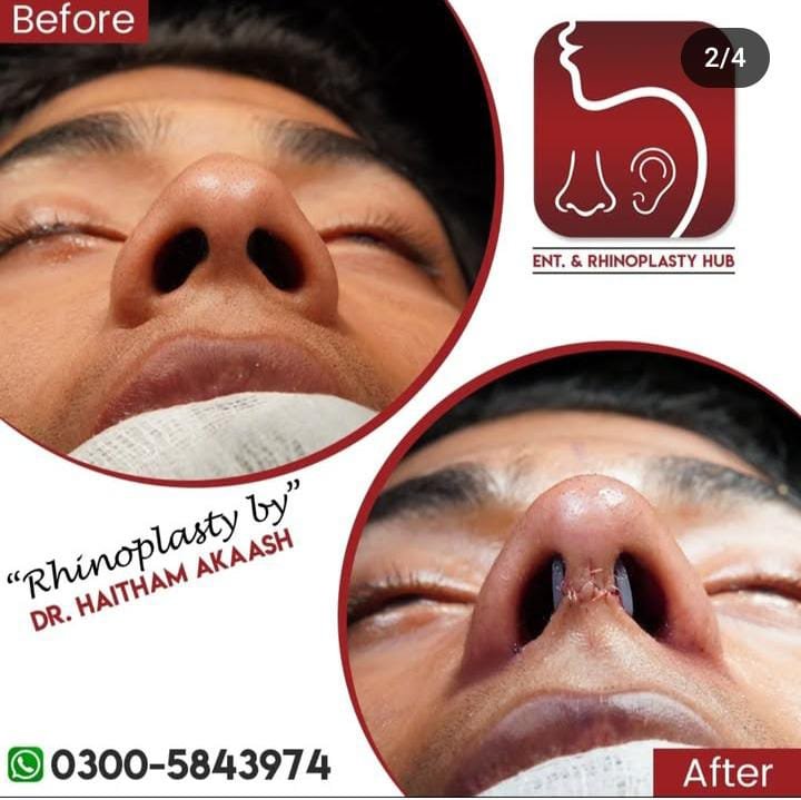 ENT. & RhinoPlasty Hub