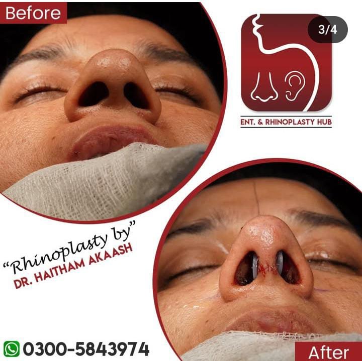 ENT. & RhinoPlasty Hub
