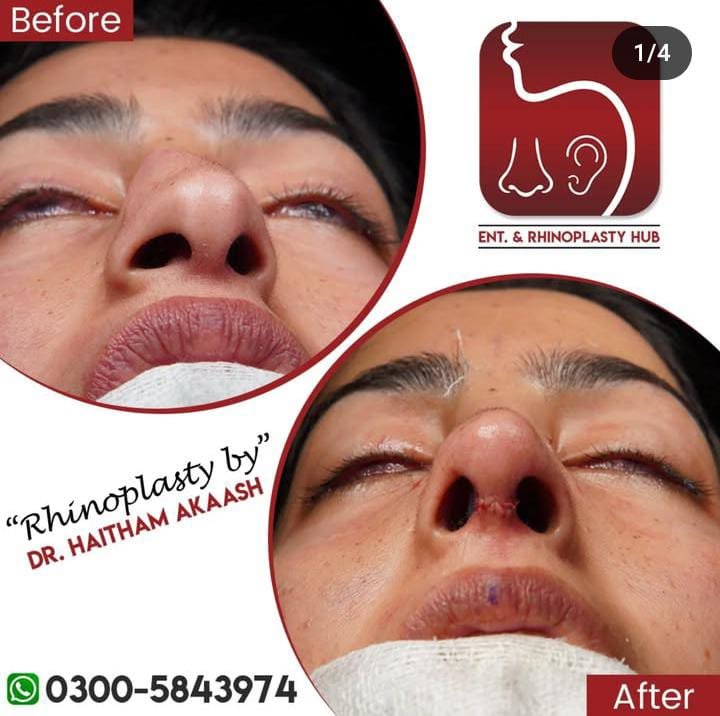 ENT. & RhinoPlasty Hub