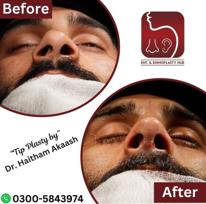 ENT. & RhinoPlasty Hub