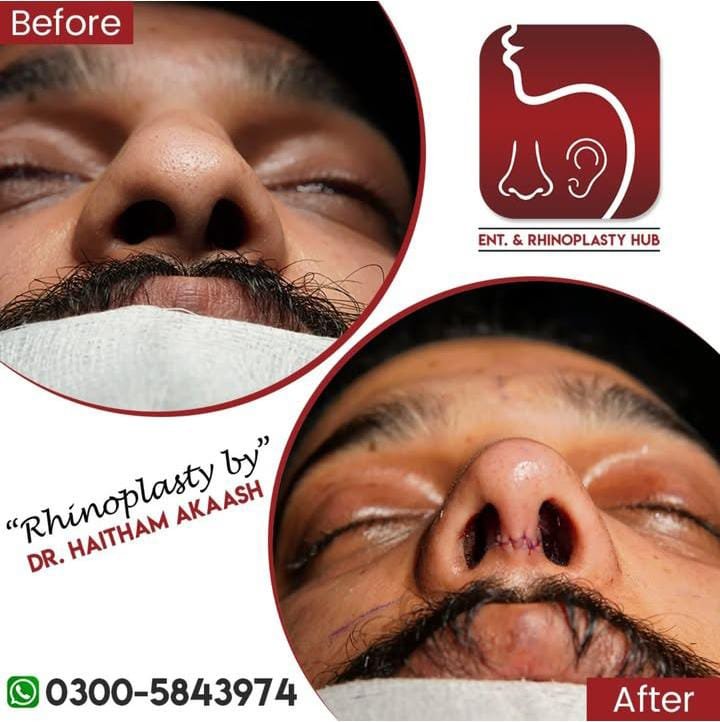 ENT. & RhinoPlasty Hub