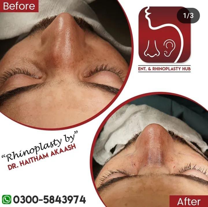 ENT. & RhinoPlasty Hub