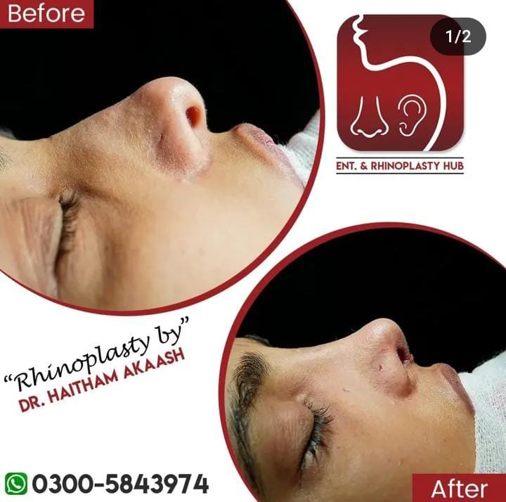 ENT. & RhinoPlasty Hub