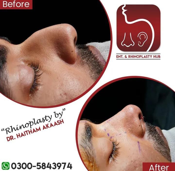 ENT. & RhinoPlasty Hub