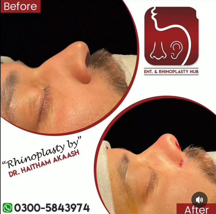 ENT. & RhinoPlasty Hub