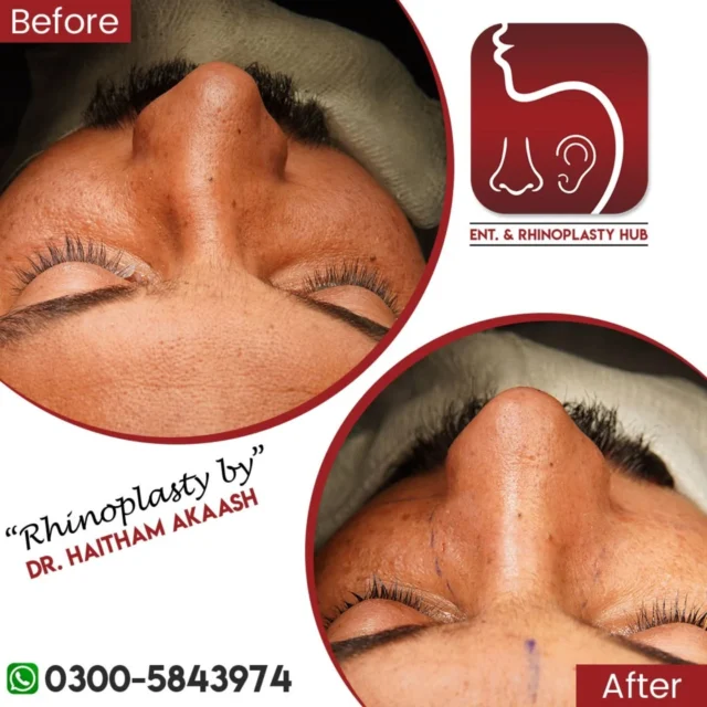 ENT. & RhinoPlasty Hub