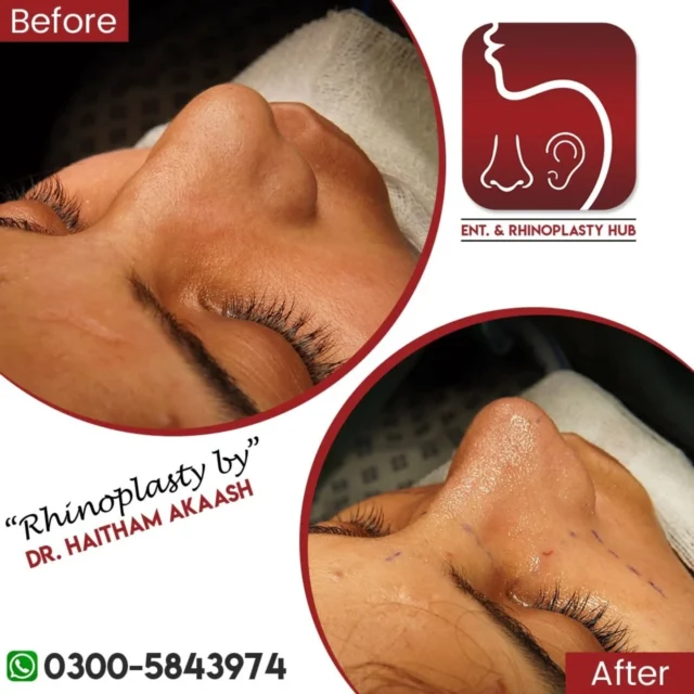 ENT. & RhinoPlasty Hub