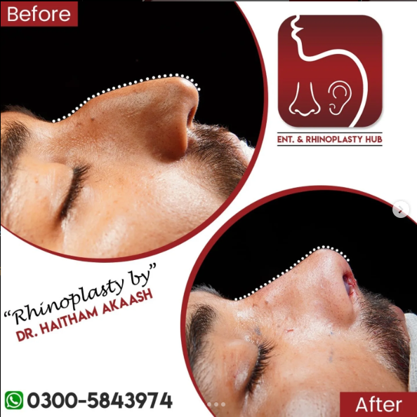 ENT. & RhinoPlasty Hub